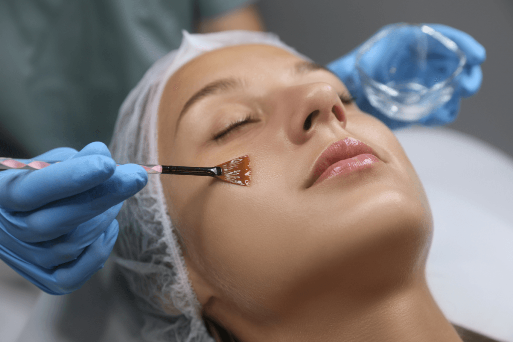 Chemical Peel for Hyperpigmentation