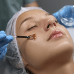 Chemical Peel for Hyperpigmentation