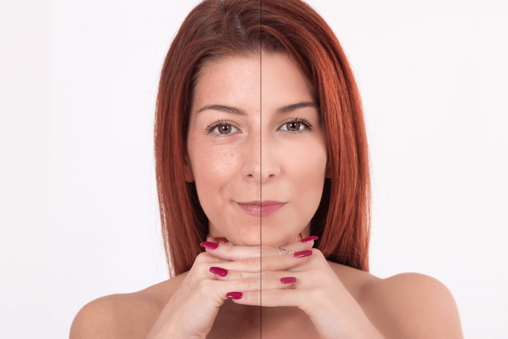 Juvederm Before And After