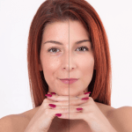 Juvederm Before And After