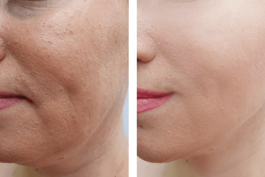 Juvederm Before And After Cheeks