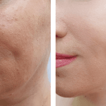 Juvederm Before And After Cheeks