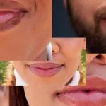 Lip Fillers Swelling Stages: Timeline, Safety, and Follow-Up