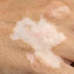 Hypopigmentation of the Skin: Assessment and Care
